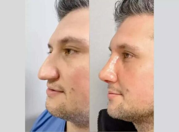 Male Rhinoplasty