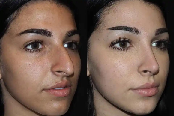 Top Dubai Rhinoplasty Surgeons