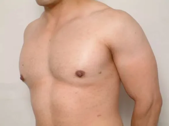 Gynecomastia in Athletes