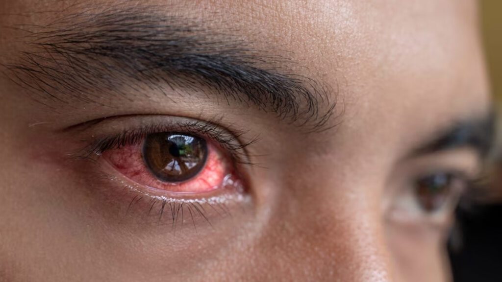 Bloodshot Eyes