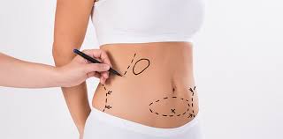 Riyadh Top Hub for Liposuction